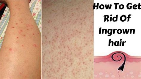 Top 5 Home Remedies To Get Rid Of Ingrown Hair And Red Bumps Home