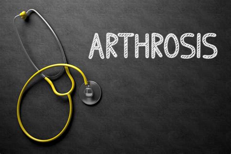 Frequently Asked Questions About Arthrosis Facty Health