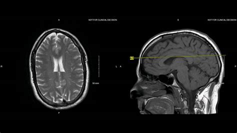 Unremarkable Non Contrast Brain Mri Axial T2 Example 1 Youtube