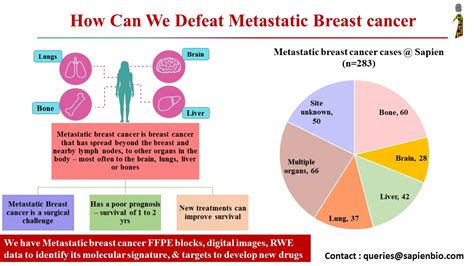 20 30 Of Patients With Potentially Curable Breast Cancer Develop