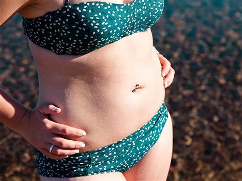 Psoriasis In The Belly Button Symptoms Causes And Treatment