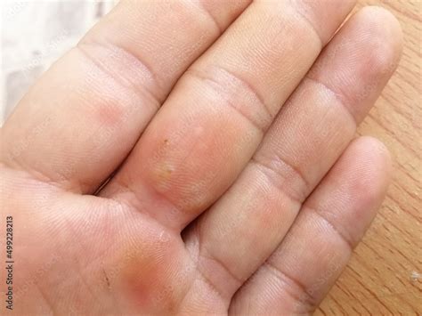 Transparent Blister On The Finger Dyshidrotic Eczema Dyshidrosis Or