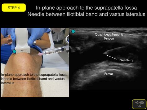 Arthrocentesis Knee — Highland Em Ultrasound Fueled Pain Management