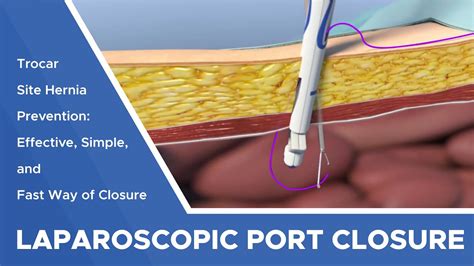 Effective Simple And Fast Way Of Laparoscopic Port Closure For Trocar