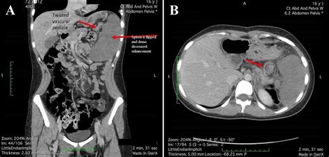 Cureus Rare Cause Of Abdominal Pain In An Adolescent Patient Splenic