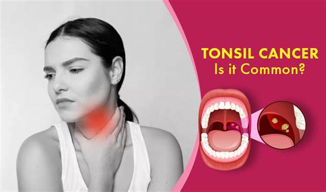 Tonsil Cancer Is It Common How Common Is Tonsil Cancer