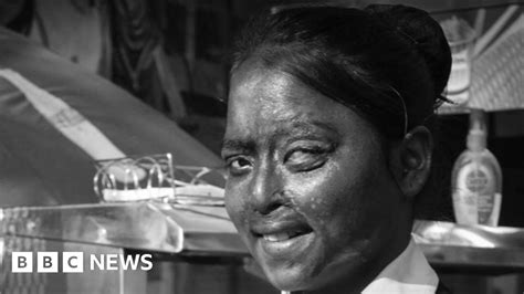 Victims Of An Acid Attacks Rebuild Their Lives Bbc News