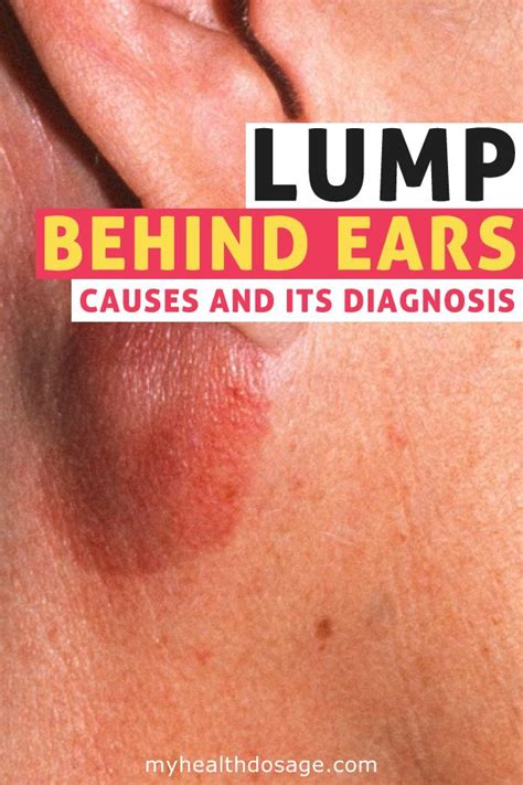 Painful Hard Lump Behind Ear On Skull Samelevel