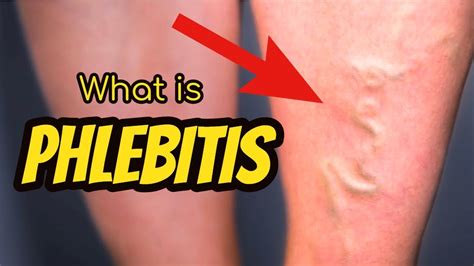 What Is Phlebitis Youtube