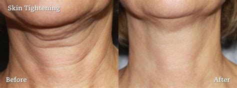 Before And After Pictures Of A Woman With Neck Wrinkled Who Has Had A