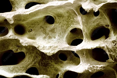 Human Femur Spongy Or Cancellous Bone Stock Image C0051054