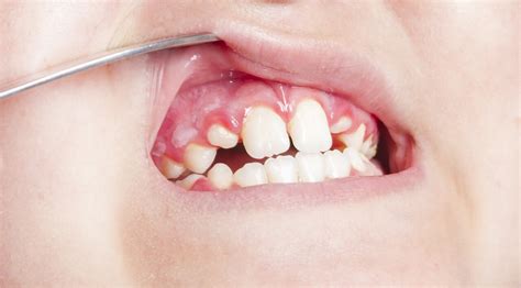 All You Need To Know About Gingivitis Stomatitis