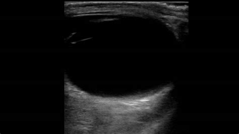 Ultrasound Examination Of Extraocular Muscles Youtube