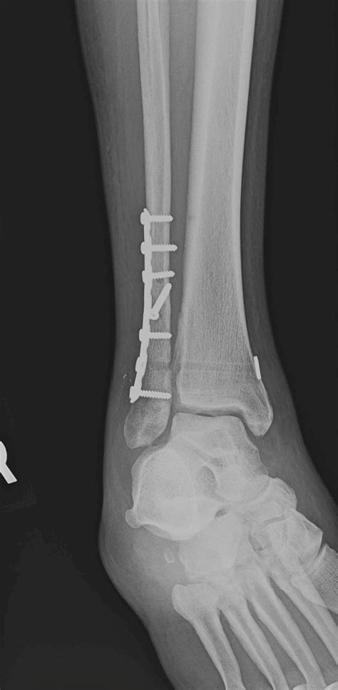 What Ankle Fracture Treatment Is Right For You Town Center Orthopaedics