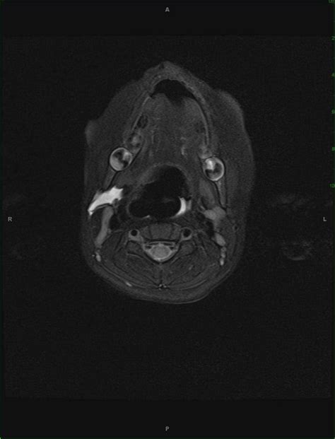 Second Branchial Cleft Cyst With Rupture Neuro Mr Case Studies