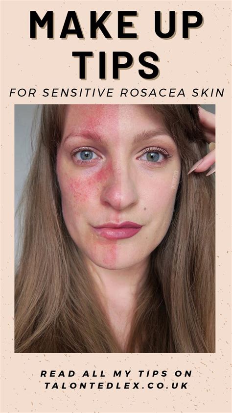 Best Makeup For Rosacea And Sensitive Skin Ivette Lundberg