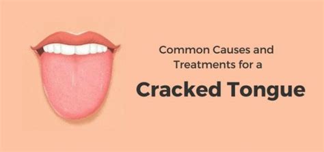 Common Causes And Treatments For Cracked Tongue Daily Health Cures