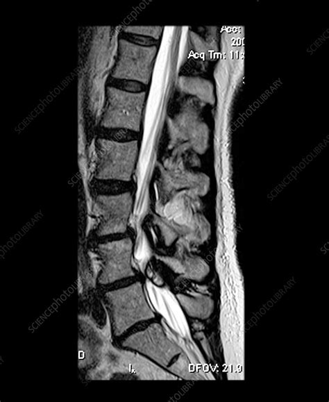 Large Synovial Cyst With Spinal Steno Stock Image M1300907 Science
