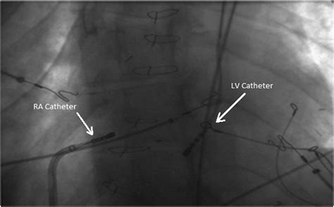Fluoroscopy Image Of The Two Mappingablation Catheters With The Second