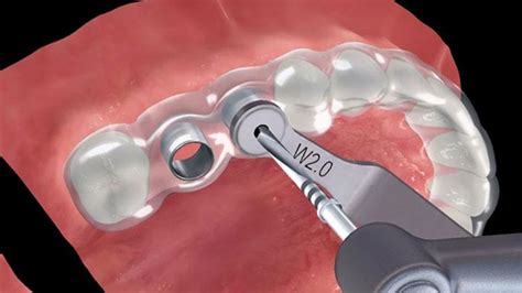 Surgically Guided Implants No More Dentures Southern Minnesota