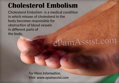Cholesterol Embolism Or Purple Toe Syndrome Purple Toes Sensory