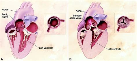 Aortic Valve Disease Circulation