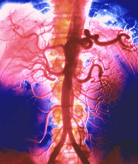 Arteriogram Of Abdominal Arteries Photograph By Alain Pol Ismscience