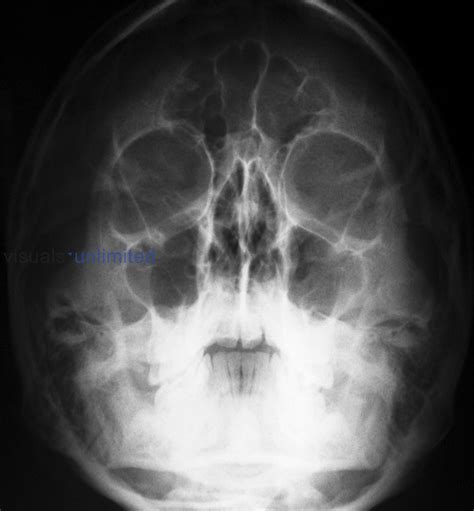 Normal Skull X Ray Showing The Frontal And Maxillary Sinuses Visuals My Xxx Hot Girl