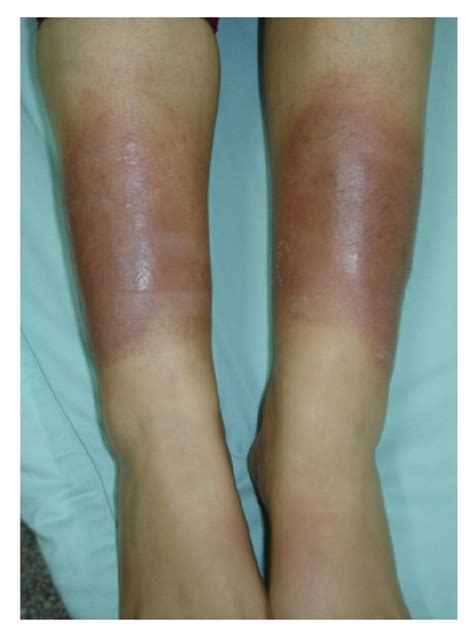Diffuse Swelling Variant A Well Circumscribed Erythematous And