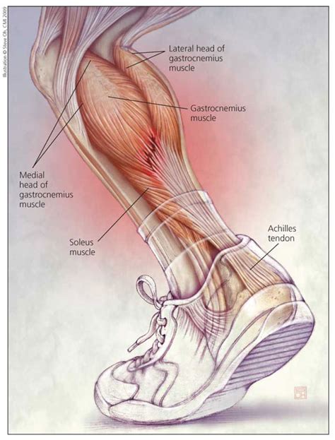 Muscle performance in neck pain assessment and rehab of the deep. Chronic Achilles Tendon Problems: An Overview