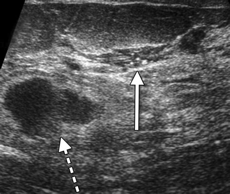 Correlation Between Sonographic Findings And Clinicopathologic And