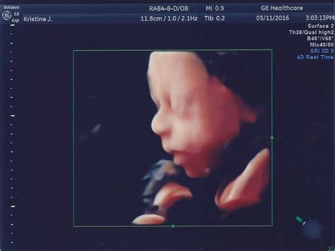 3 D Ultrasound Pictures Kristineserendipity