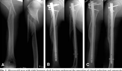 Table 1 From Antegrade Interlocking Intramedullary Nailing In Humeral