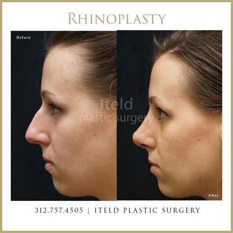 Before And After Rhinoplasty Rhinoplasty Facial Procedure Plastic Surgery