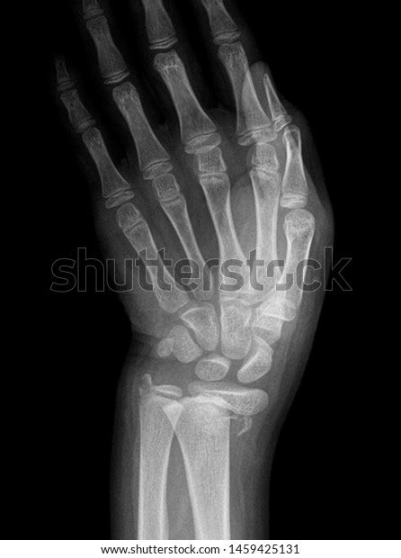 Wrist X Ray Anatomy Radiology Radiographic Stock Photo Edit Now