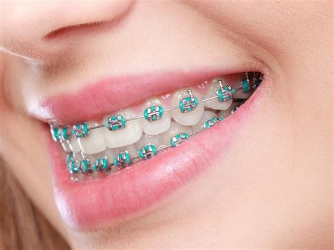 Popular Myths About Metal Braces Cleburne Hart Orthodontics