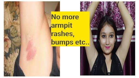 How To Get Rid Of Armpit Rashes Bumps Etc And Get Soften Armpits Armpit Talks Part 4 Kanak