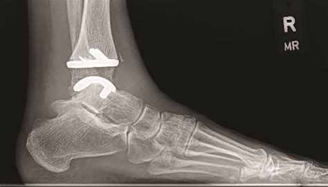 Keys To Maximizing Outcomes With Fourth Generation Total Ankle Replacements