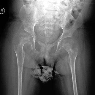 Radiograph showing the fracture in proximal tibia ...