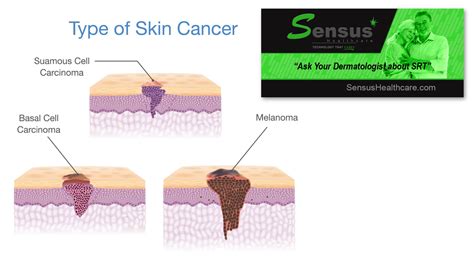 Skin Cancer Signs Treatment Melanoma Symptoms Pictures Causes And