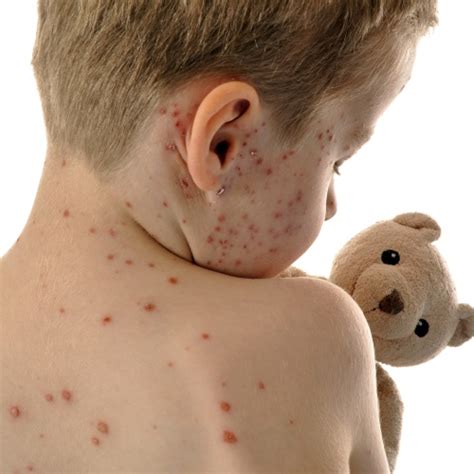 Das pfeiffersche drüsenfieber (infektiöse mononukleose) ist eine oft harmlos verlaufende, häufig auftretende viruserkrankung. Kinderkrankheiten & Kinderbeschwerden - Elternwissen.com