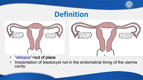 PPT Ectopic Pregnancy PowerPoint Presentation Free Download ID