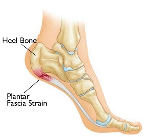 fit for life wellness and rehab centre plantar fasciitis