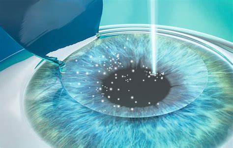 großartig Bilder Augen Lasern Ab Wann Augen Lasern Lassen Methoden Risiken Beim