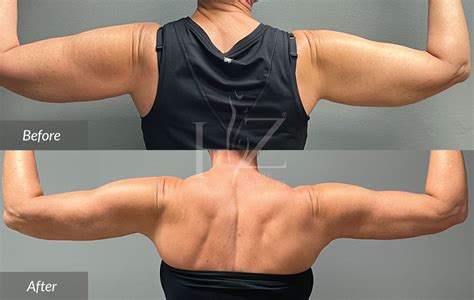 Arm Lift Before And After — Hz Plastic Surgery