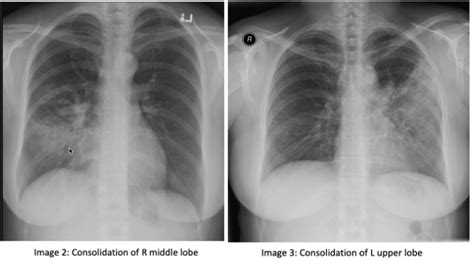 Consolidation Chest X Ray