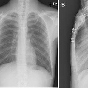 A Chest X Ray And B Sternum Lateral Plain Radiograph At Post Operative