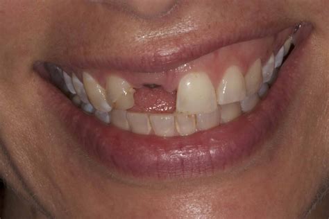 Implant Dental Case Study General And Cosmetic Dentist In Newport Beach