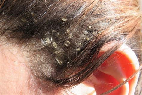 Dandruff Vs Dry Scalp Differences Causes And Home Remedies