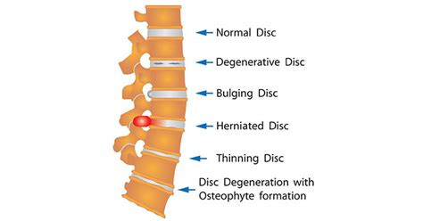 The way that i fixed my herniated disc long term. How long for Herniated disc back pain | Bulging disc back ...